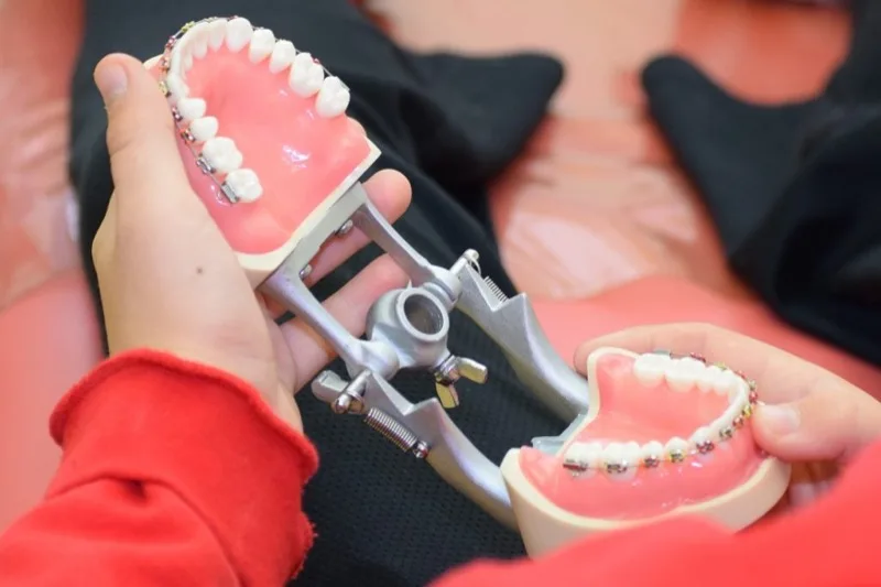 Orthodontic model showing braces used at Norwell Pediatric Dentistry